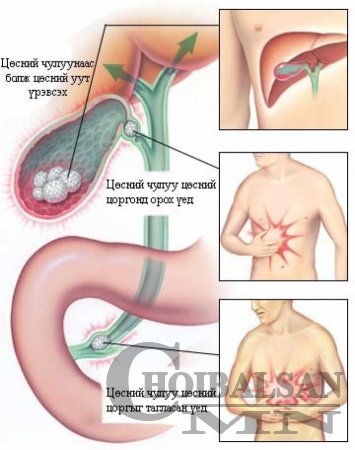 Цөс чулуужих өвчин залуужиж байгаа нь юуных вэ?