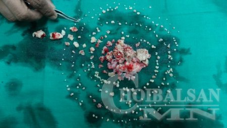 232 ширхэг шүд сугалж авлаа