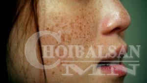 Гэрийн нөхцөлд сайрталт, сэвхийг арилгах топ 5 арга